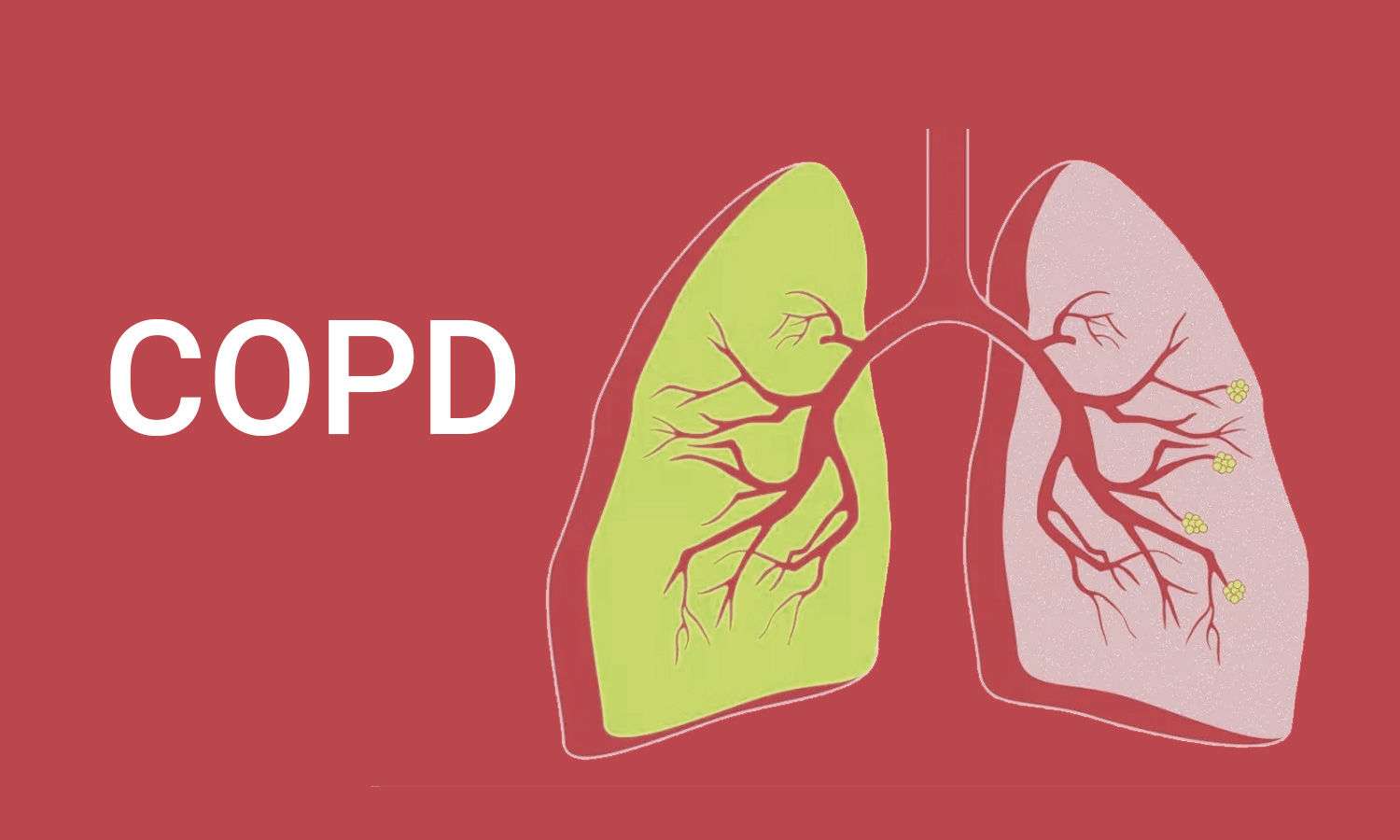 Chronic Obstructive Pulmonary Disease | POPD