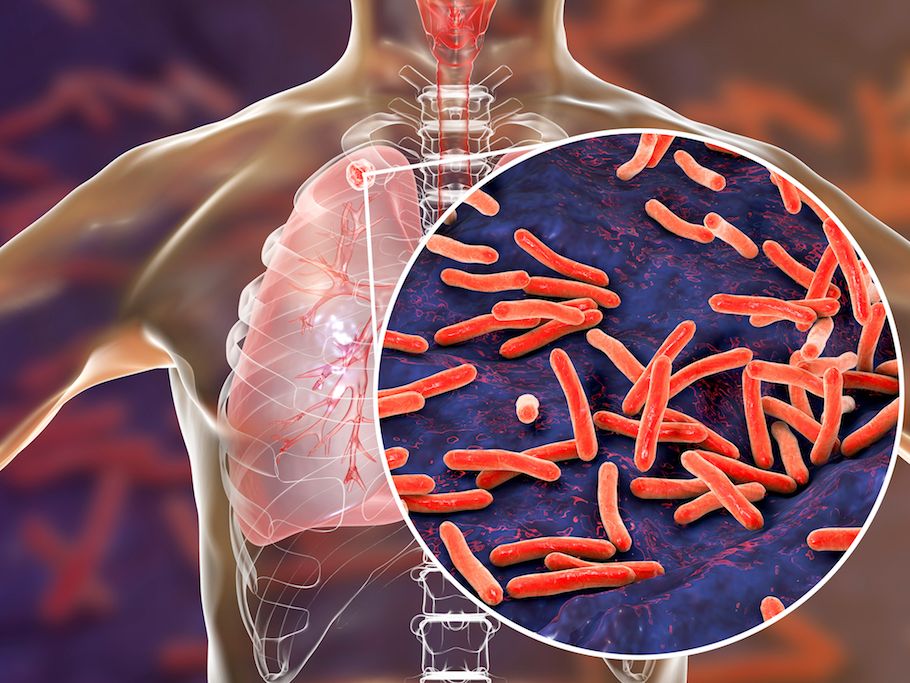 Early Signs and Symptoms of Tuberculosis